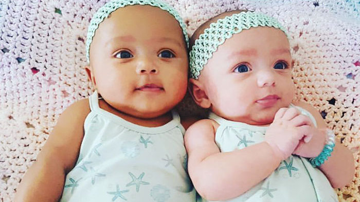 Это самые редкие близнецы в мире
