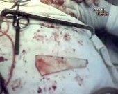 З горла пацієнта вийняли уламок скла завдовжки 8 см